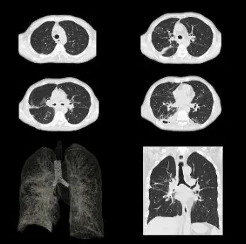 Клинические изображения Canon Aquilion ONE PRISM Edition компьютерный томограф