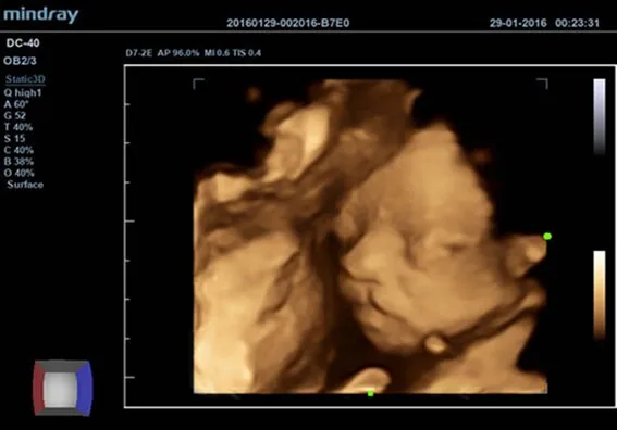 Клинические изображения УЗИ аппарат Mindray DC-40 Exp