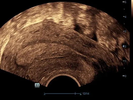 Клинические изображения УЗИ аппарат Mindray DC-70 Exp