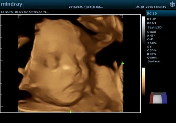 Клинические изображения УЗИ аппарат Mindray DC-28