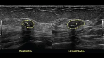 Клинические изображения GE HealthCare Logiq E10 ультразвуковая система