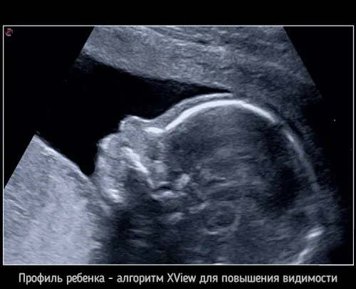 Клинические изображения УЗИ аппарат Esaote MyLab X8