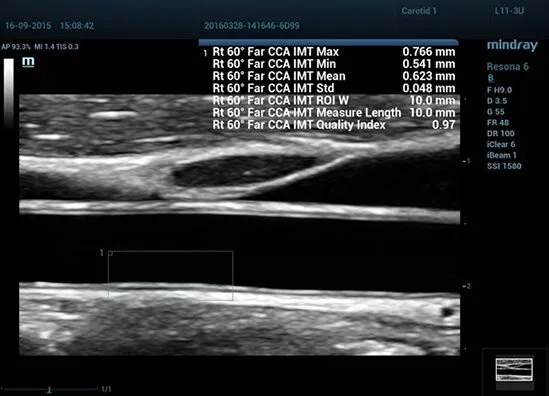 Клинические изображения УЗИ аппарат Mindray Resona 6
