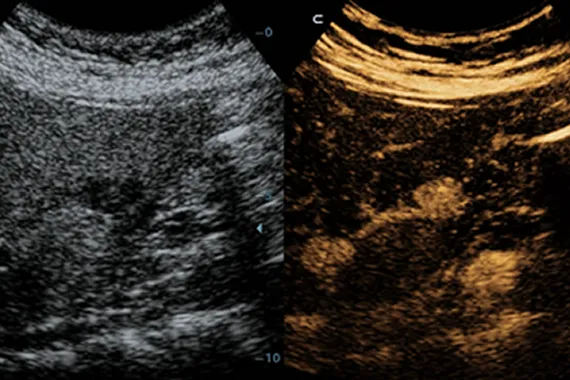 Клинические изображения УЗИ аппарат Mindray DC-45