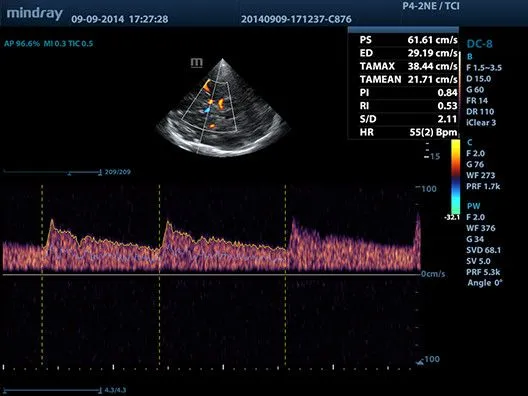 Клинические изображения УЗИ аппарат Mindray DC-8 Exp