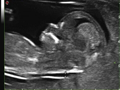 Клинические изображения УЗИ аппарат Esaote MyLab ClassC