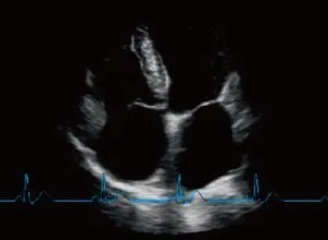 Клинические изображения УЗИ аппарат Chison SonoTouch 80 Pro портативный