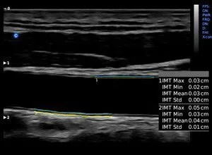 Клинические изображения УЗИ аппарат Chison SonoTouch 80 Pro портативный