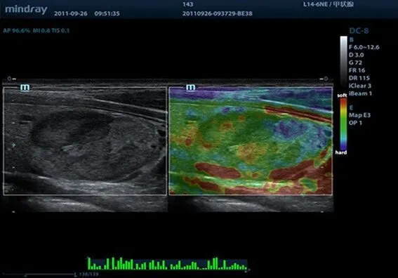 Клинические изображения УЗИ аппарат Mindray DC-8