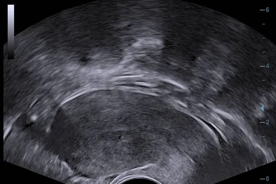Клинические изображения УЗИ аппарат Mindray DC-45