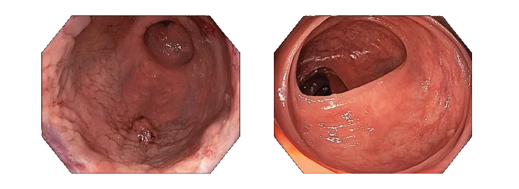 Esophagogastroduodenoscopy-with-Olympus-GIF-HQ190-and-Colonoscopy-with-Olympus-CF-HQ190LI.png