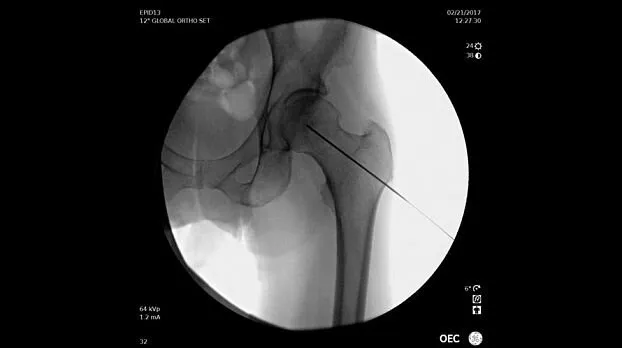 Клинические изображения Рентгенохирургический аппарат типа С-дуга GE OEC Elite II