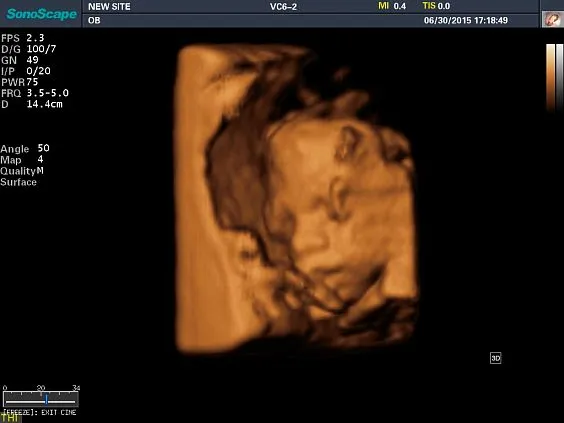 Клинические изображения Sonoscape S8 Exp ультразвуковой аппарат