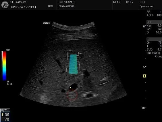 Клинические изображения GE HealthCare Logiq P10 ультразвуковой аппарат