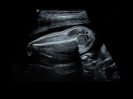 Клинические изображения УЗИ аппарат GE HealthCare Voluson E8 