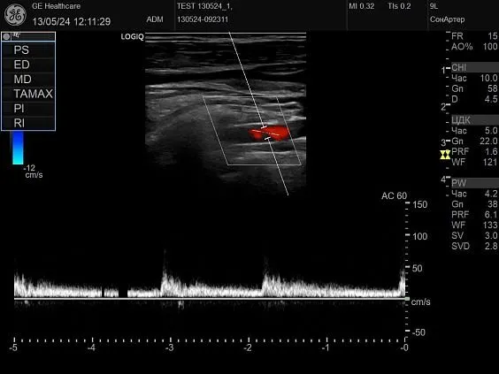 Клинические изображения GE HealthCare Logiq P10 ультразвуковой аппарат
