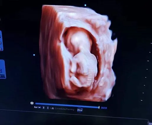 Клинические изображения Chison Qbit 6 ультразвуковой аппарат