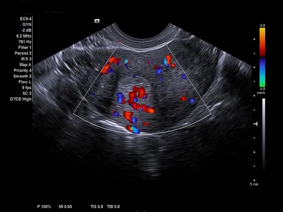 Клинические изображения Siemens Acuson NX2 аппарат УЗИ