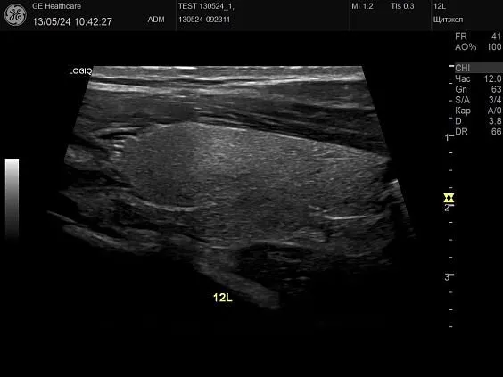 Клинические изображения GE HealthCare Logiq P10 ультразвуковой аппарат