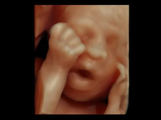 Клинические изображения Ультразвуковая диагностическая система GE Voluson E10