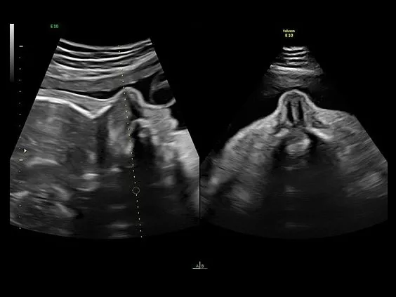 Клинические изображения Ультразвуковая диагностическая система GE Voluson E10