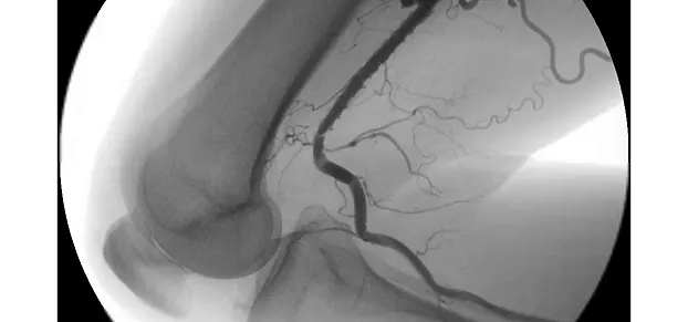 Клинические изображения Philips BV Pulsera С-дуга