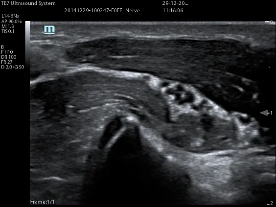 Клинические изображения УЗИ аппарат Mindray TE7 портативный