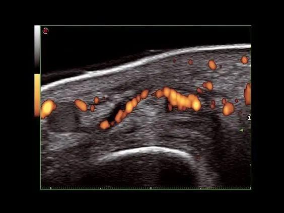 Клинические изображения УЗИ аппарат Esaote MyLab Seven