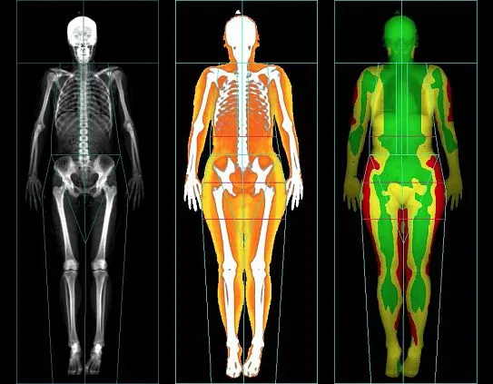 Клинические изображения Рентгеновский денситометр GE Lunar iDXA