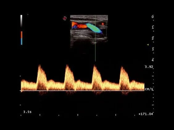 Клинические изображения УЗИ аппарат Esaote MyLab Seven