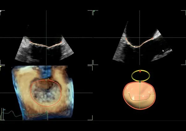 Клинические изображения Ультразвуковая диагностическая система GE HealthCare Vivid E95