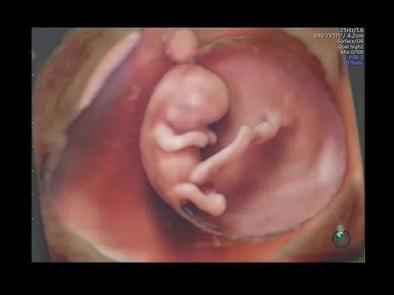 Клинические изображения Ультразвуковая диагностическая система GE Voluson E10