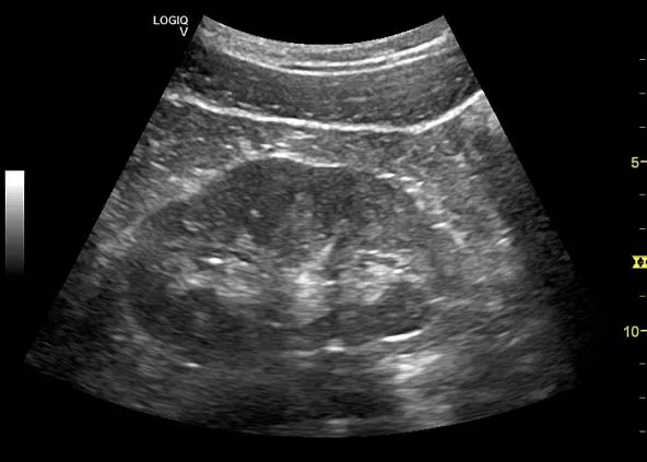 Клинические изображения Ультразвуковая диагностическая система GE Logiq V5