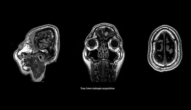 Клинические изображения МРТ аппарат GE SIGNA Voyager 1.5T