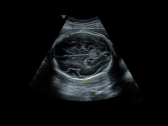 Клинические изображения УЗИ аппарат GE HealthCare Voluson E8 