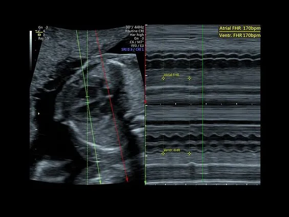 Клинические изображения УЗИ аппарат GE HealthCare Voluson P8