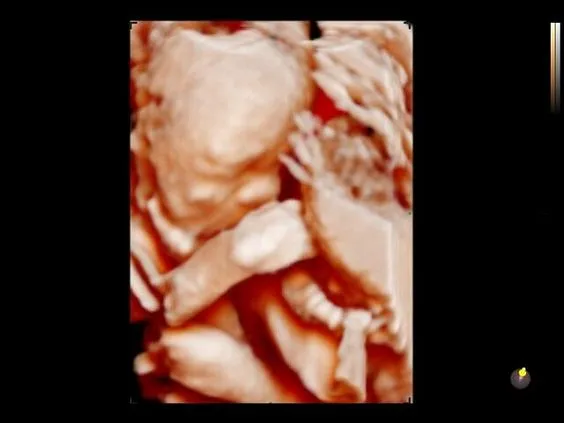 Клинические изображения УЗИ аппарат НПО СКАНЕР РУСКАН 60