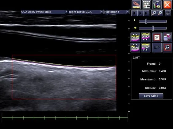 Клинические изображения Siemens Acuson NX2 аппарат УЗИ