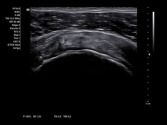 Клинические изображения Ультразвуковая система Siemens Acuson NX3 Elite