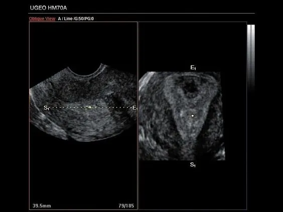 Клинические изображения Samsung Medison HM70A УЗИ аппарат портативный