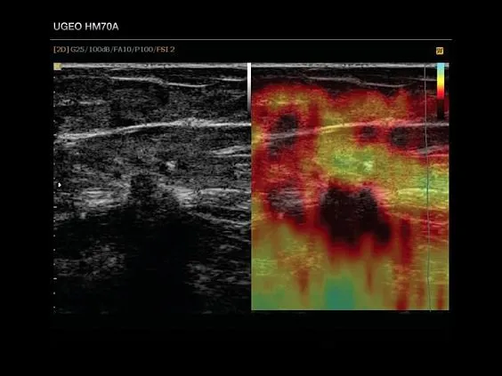 Клинические изображения Samsung Medison HM70 EVO УЗИ аппарат портативный