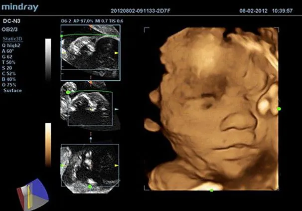 Клинические изображения УЗИ аппарат Mindray DC-N3