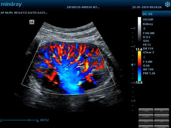 Клинические изображения УЗИ аппарат Mindray DC-28