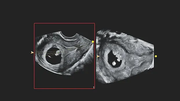 Клинические изображения Philips 5500 ультразвуковой аппарат портативный