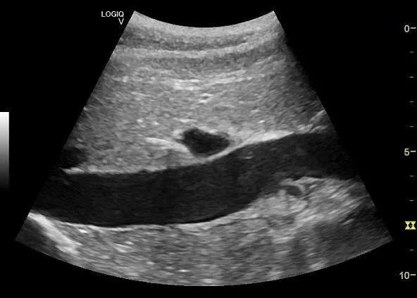 Клинические изображения Ультразвуковая диагностическая система GE Logiq V5