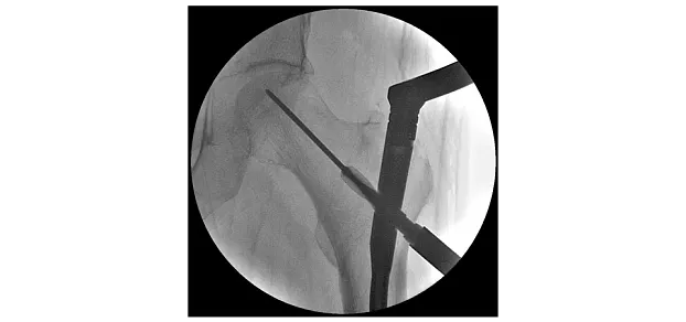 Клинические изображения Philips BV Vectra С-дуга