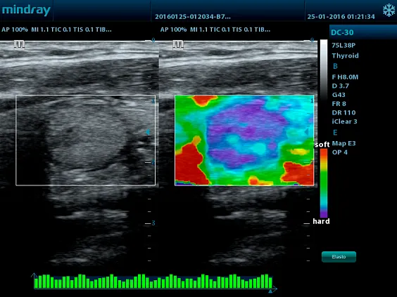 Клинические изображения УЗИ аппарат Mindray DC-28