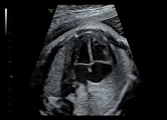 Клинические изображения Ультразвуковая диагностическая система GE HealthCare Voluson E6