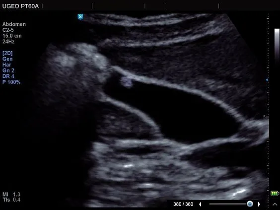 Клинические изображения Samsung Medison PT60 УЗИ аппарат