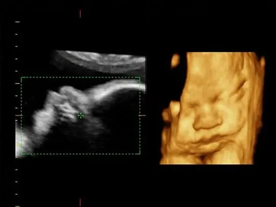 Клинические изображения УЗИ аппарат Esaote MyLab Twice